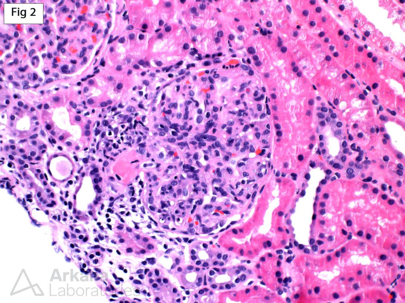 Thrombotic Microangiopathy