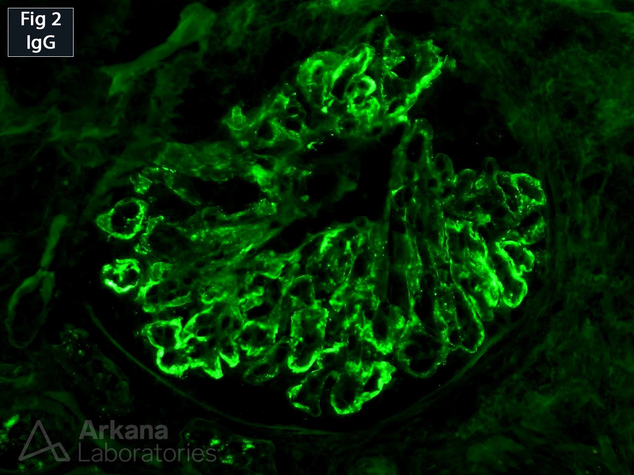 Proliferative Glomerulonephritis with Monoclonal IgG Deposits