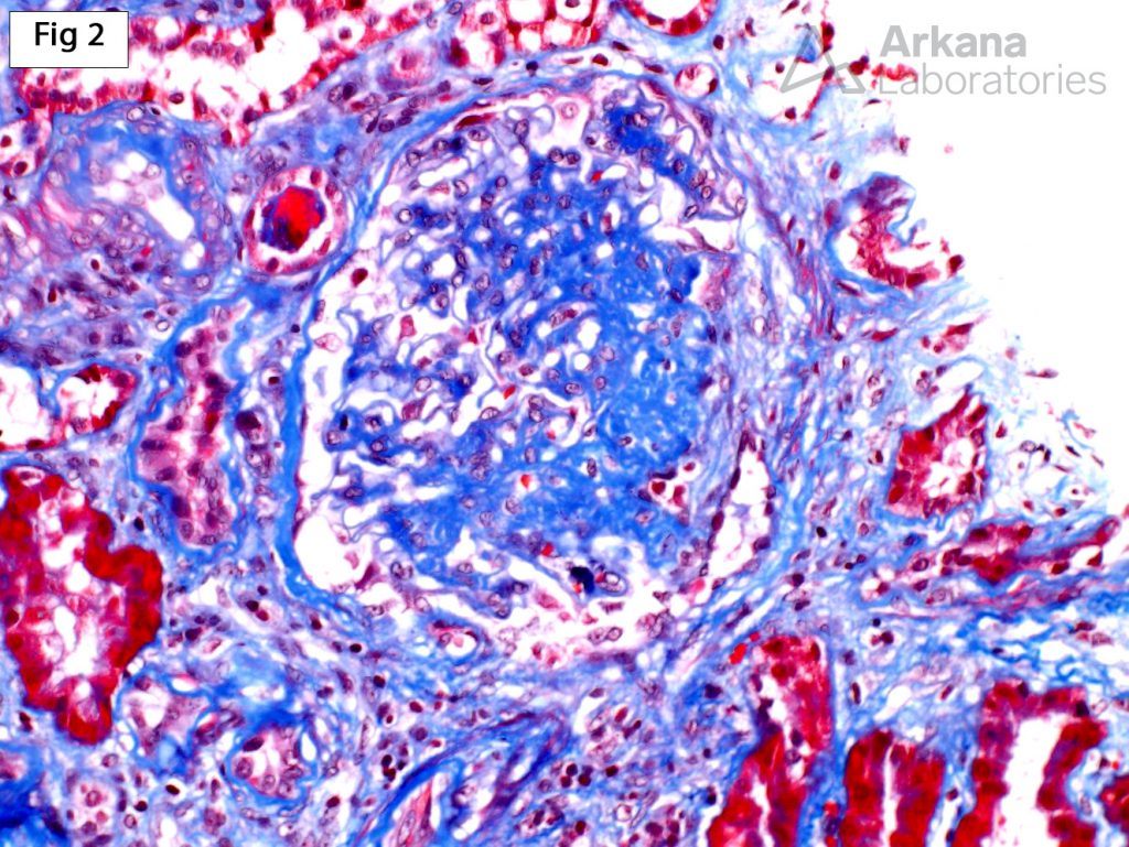 Obesity-Related Glomerulopathy, marked glomerulomegaly with focal areas of perihilar segmental glomerulosclerosis