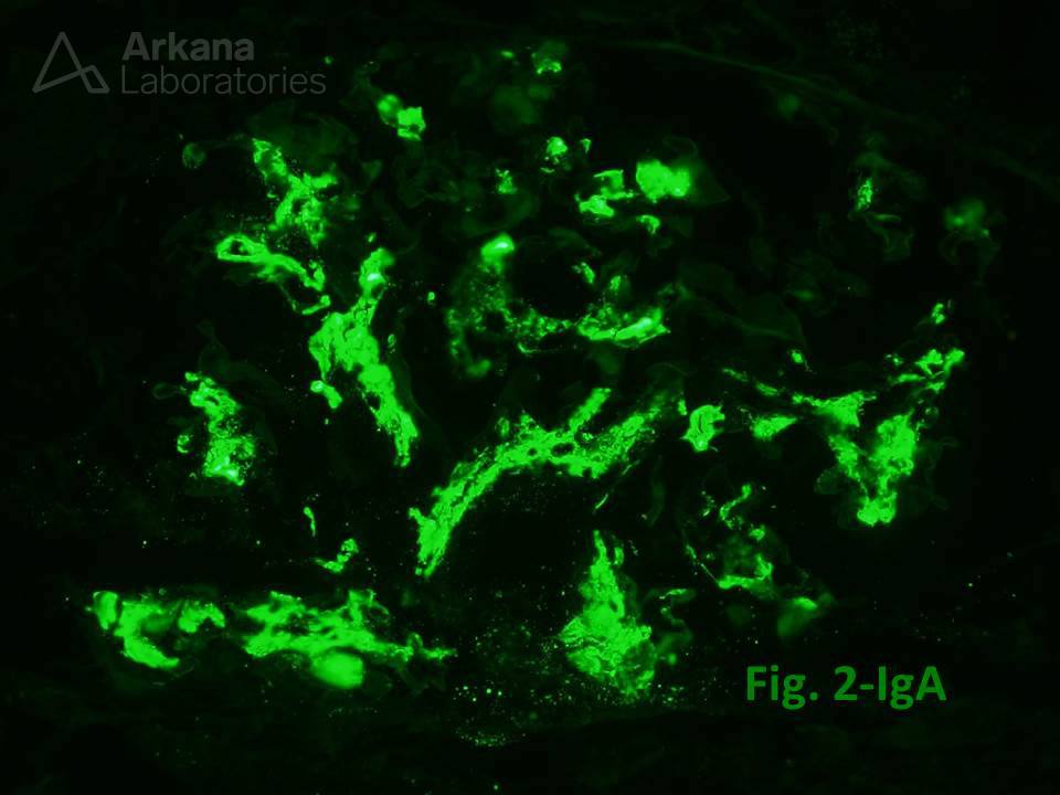 IgA nephropathy