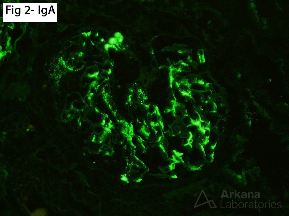 mesangial granular staining for IgA (3+), C3 (1+), kappa (2+) and lambda (3+)