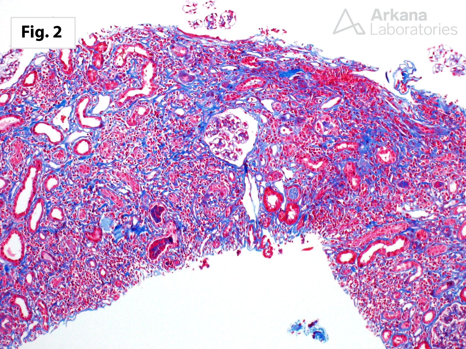 Chronic Active T Cell-Mediated Rejection