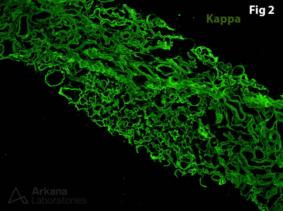 positive tubular and glomerular basement membranes for kappa light chain, Peritubular Giant Cells