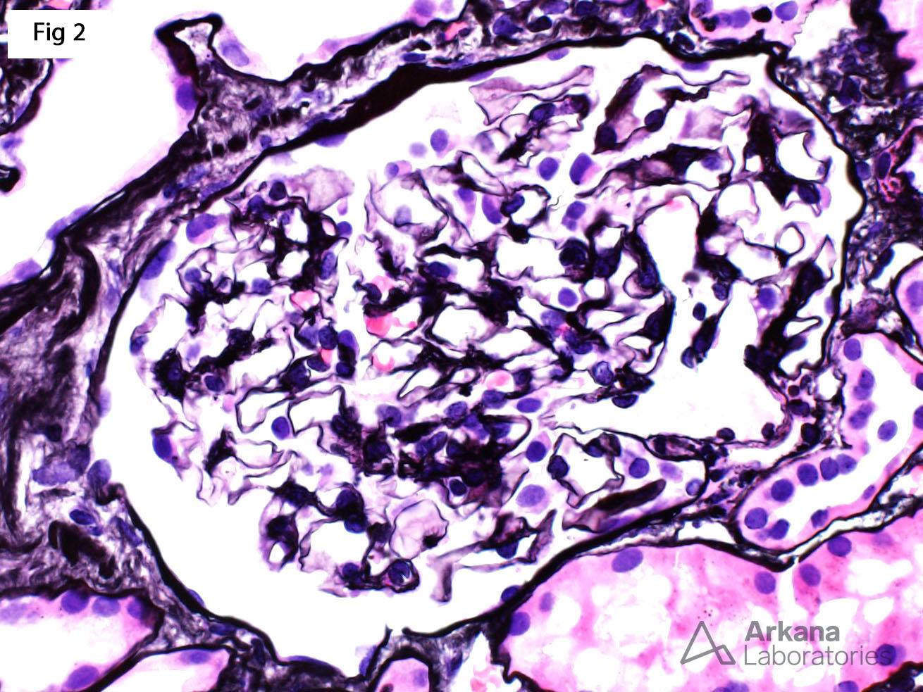 glomeruli are completely unremarkable by light microscopy, AKI