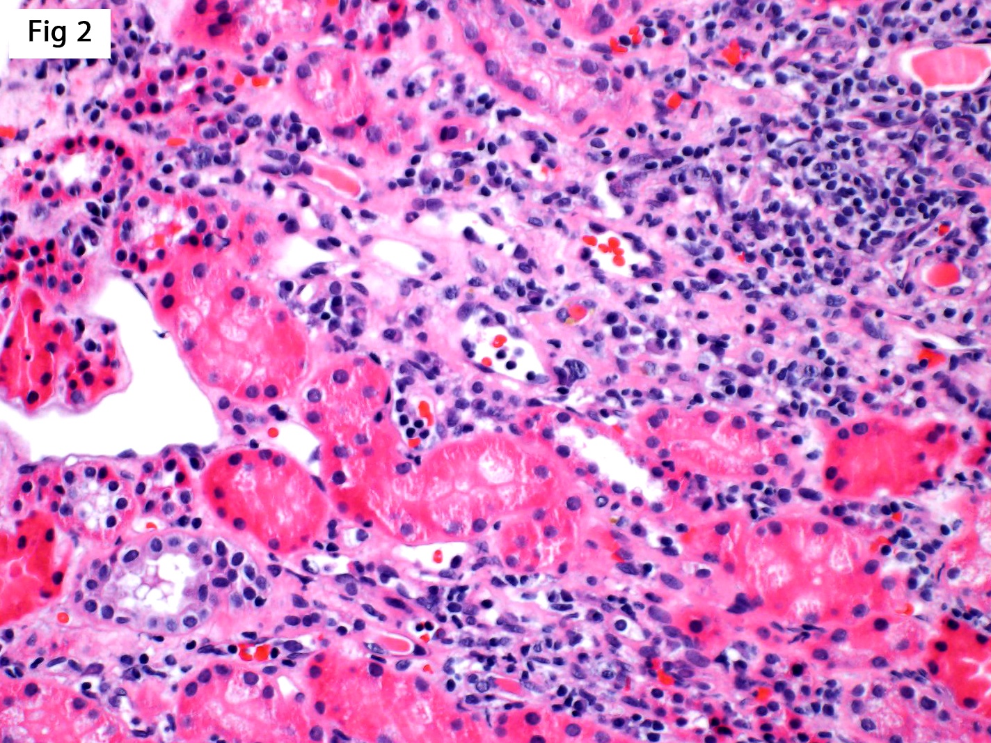 diffusely positive C4d staining in peritubular capillaries, Antibody-Mediated Rejection