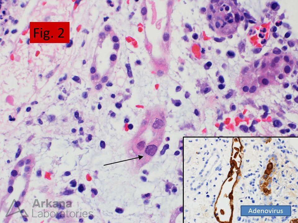 acute tubular injury with viral cytopathic effect and positive immunohistochemical cytoplasmic and nuclear staining for adenoviral antigen