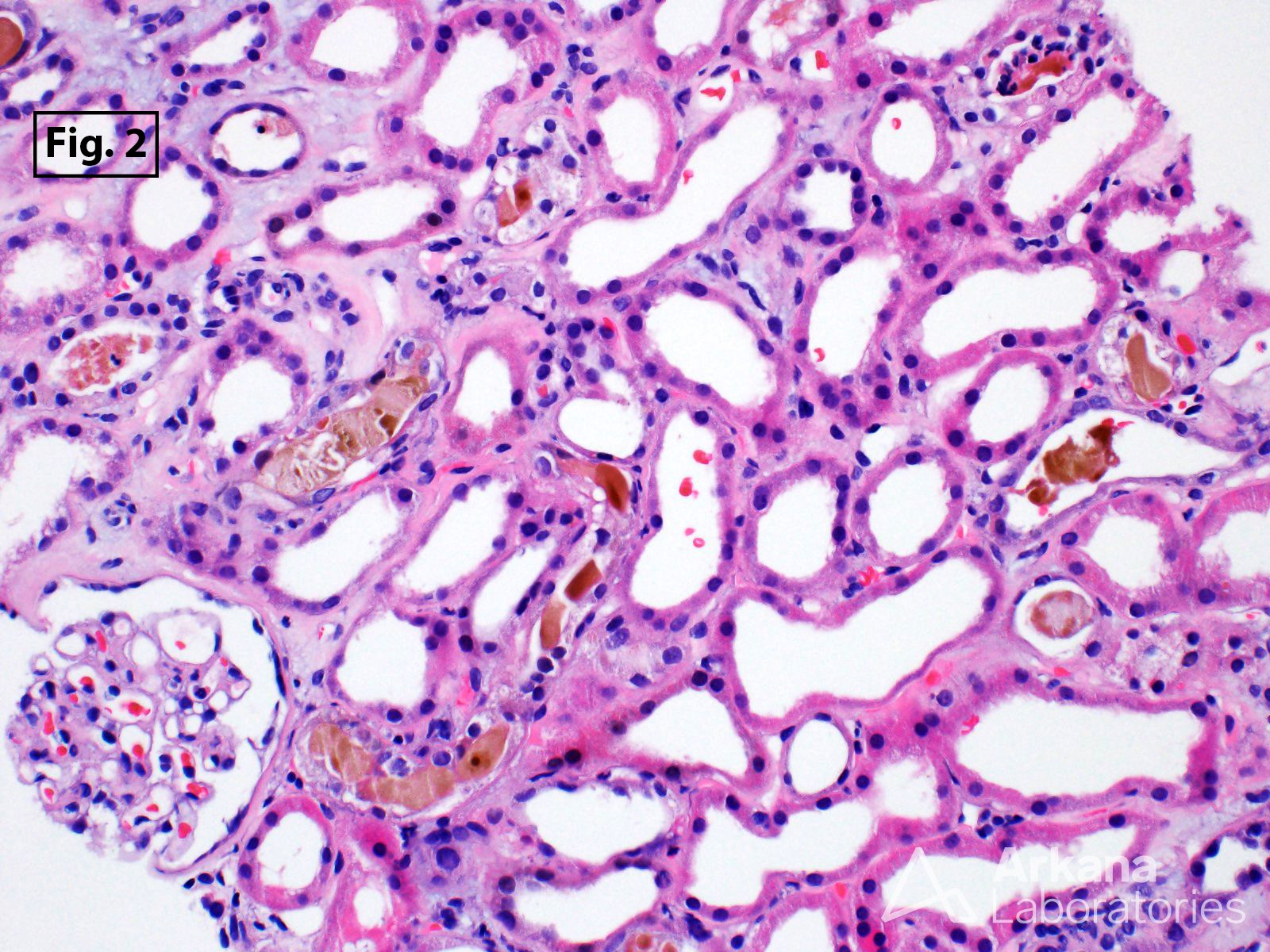 Bile Cast Nephropathy