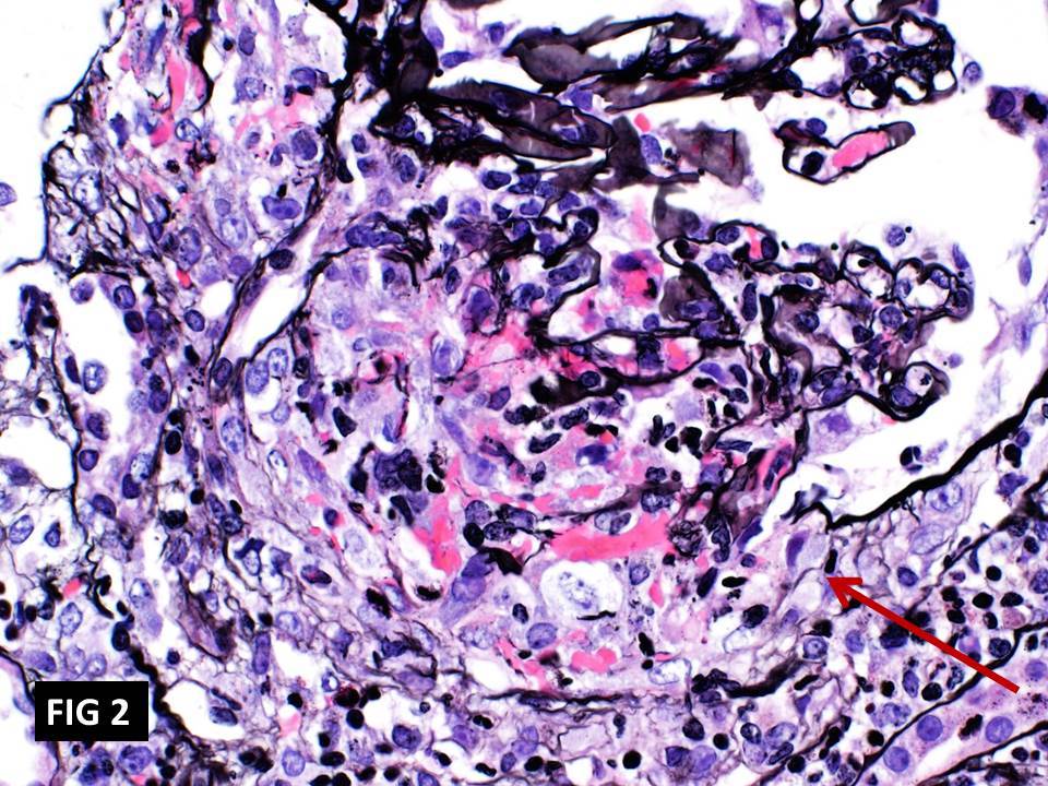 Anti-GBM (Anti-Glomerular Basement Membrane), cellular crescent associated with a prominent break in Bowman’s capsule