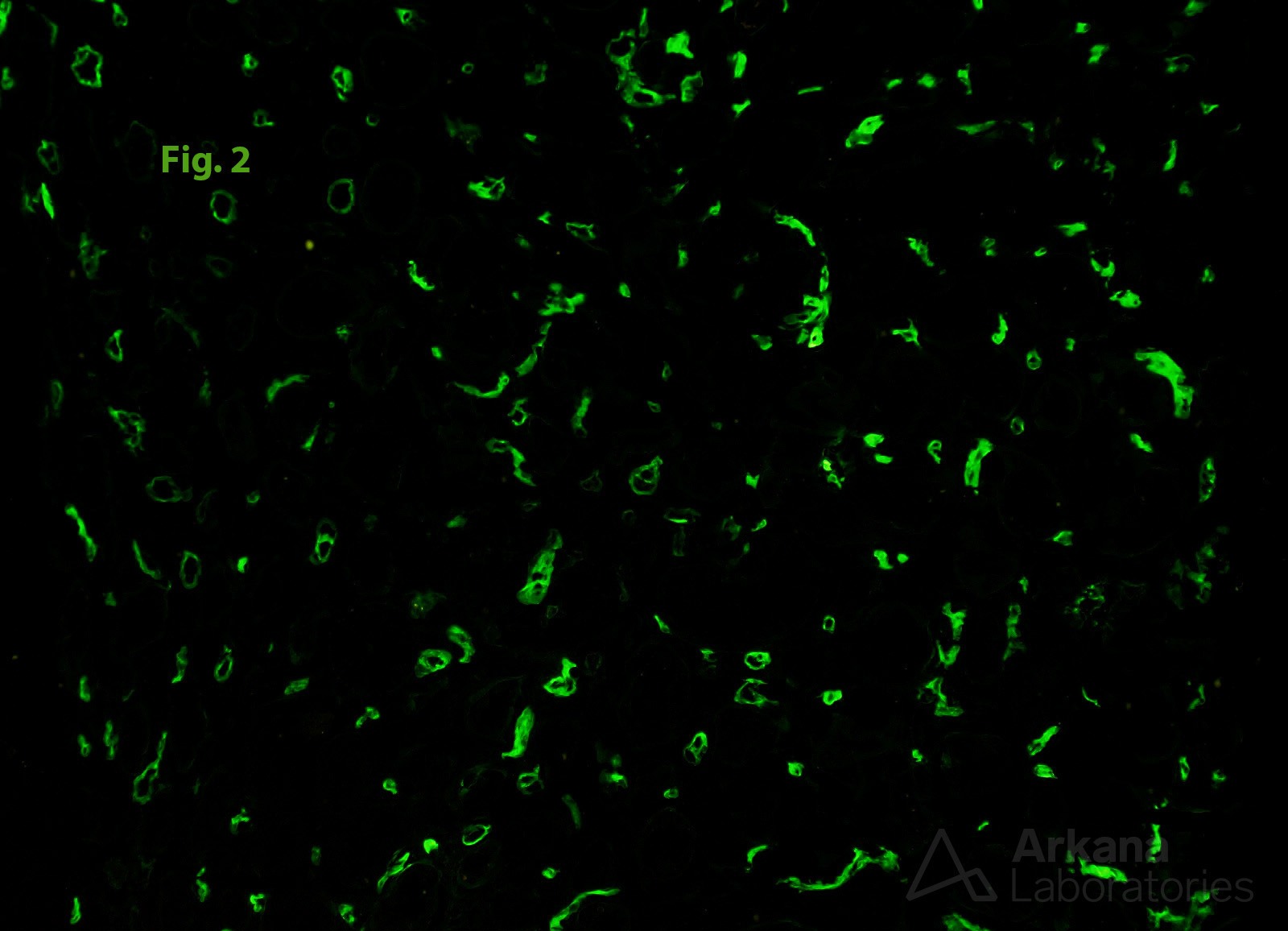 strong and diffuse linear staining of C4d in peritubular capillaries, Chronic Active Antibody-Mediated Rejection