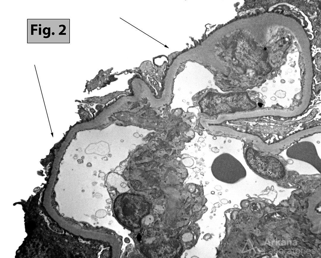 nephrotic syndrome and severe foot process effacement, FSGS