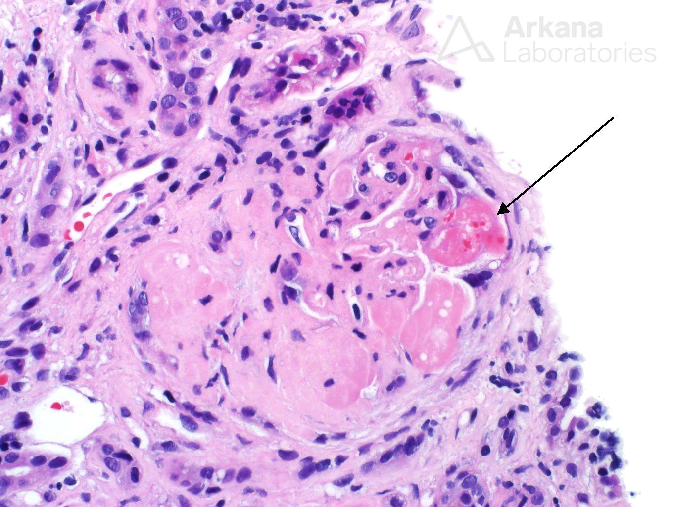 Anti-VEGF Effect