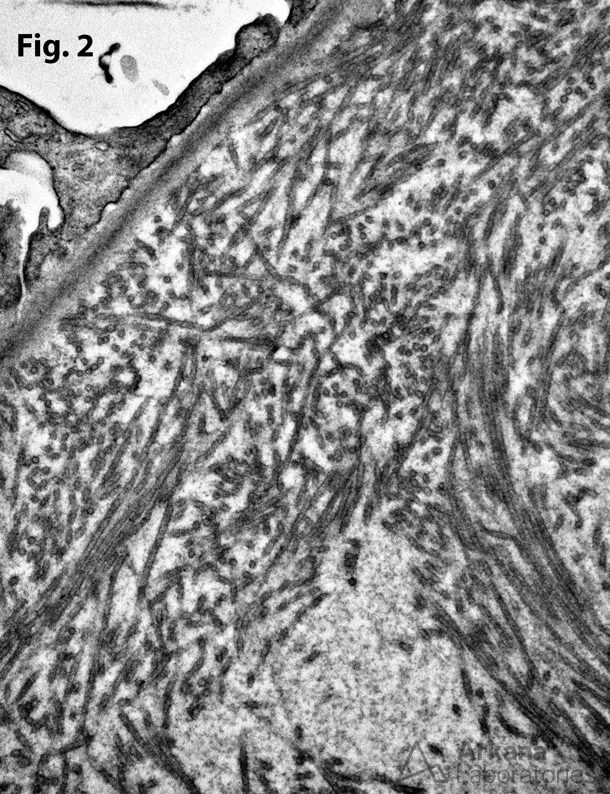 Immunotactoid Glomerulopathy, microtubule deposits seen by electron microscopy
