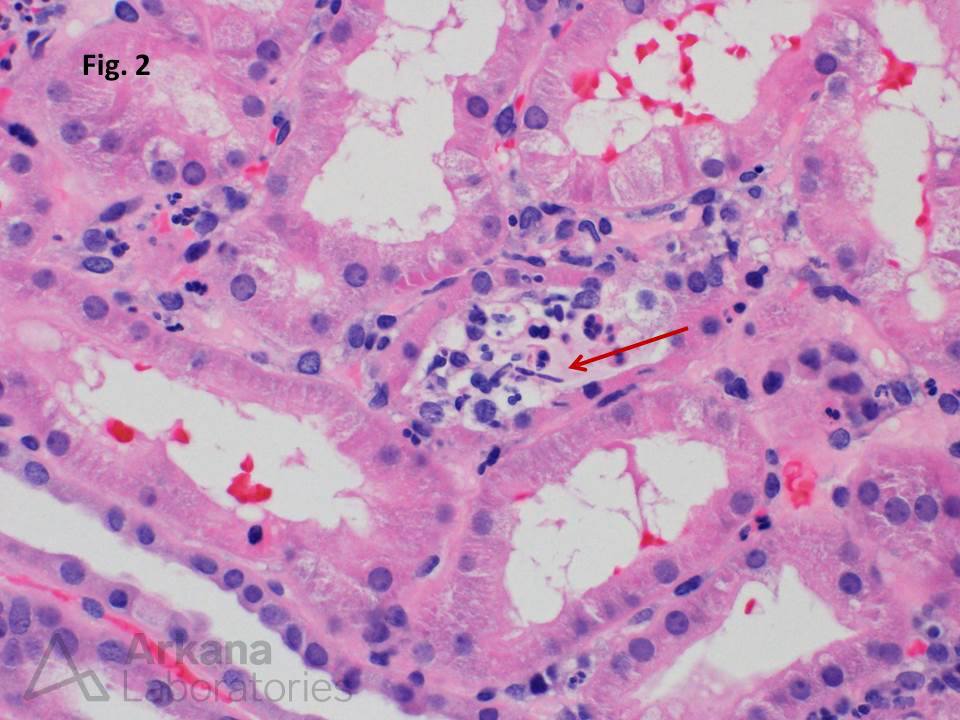 Higher magnification shows tubulitis with intratubular leukocytes and rare structures suspicious for fungal elements, Microabscess, acute kidney injury