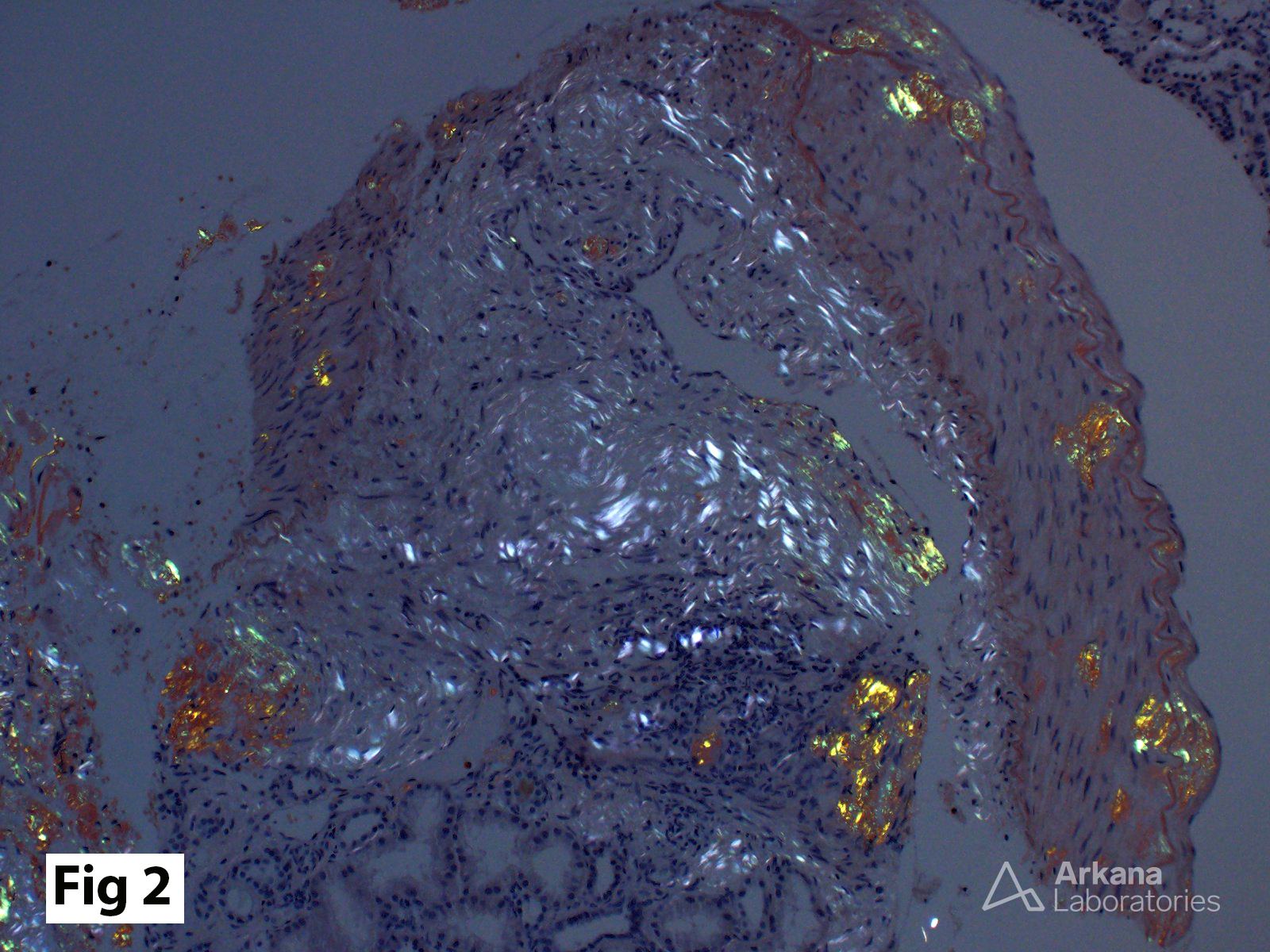 Congo red stain, polarization microscopy showing “apple-green” birefringence