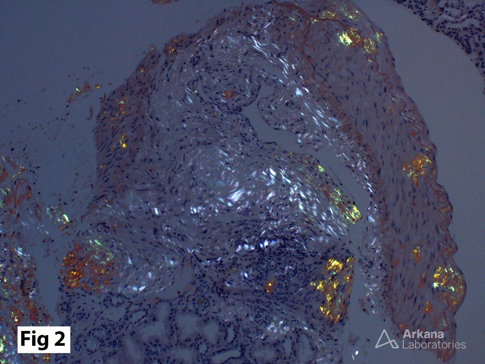 Congo red stain, polarization microscopy showing “apple-green” birefringence