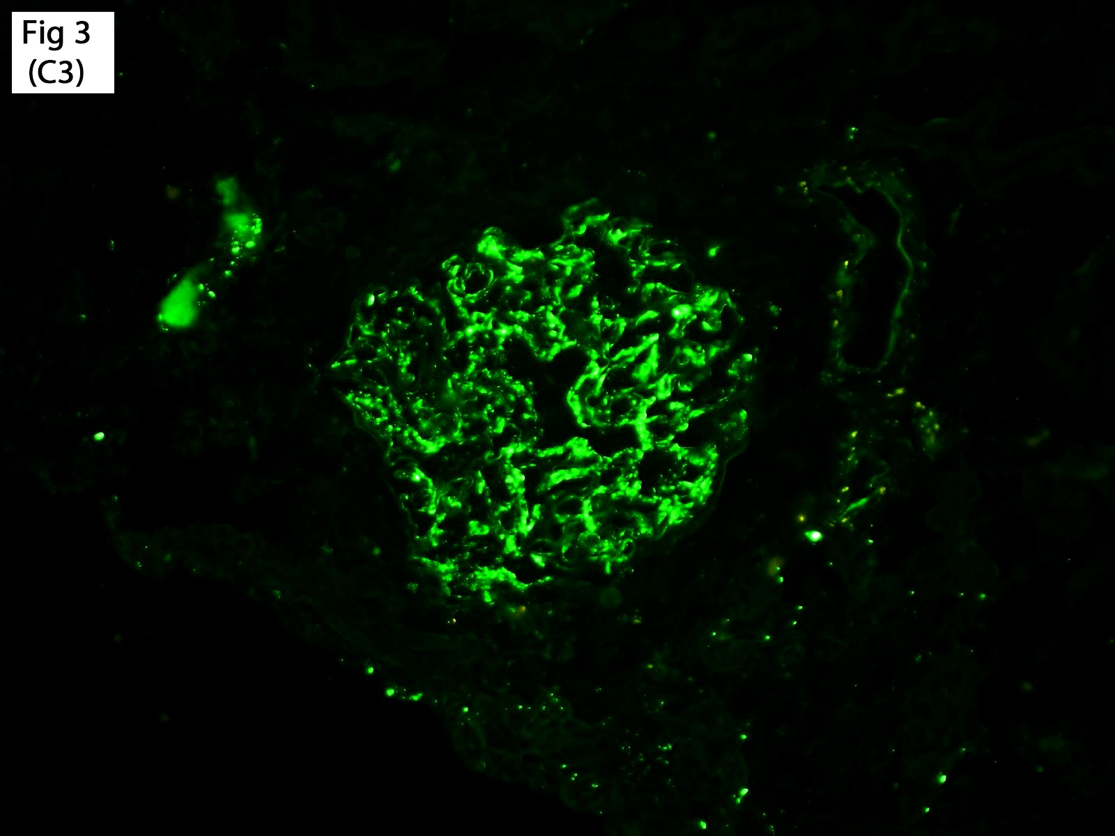 Glomerulonephritis