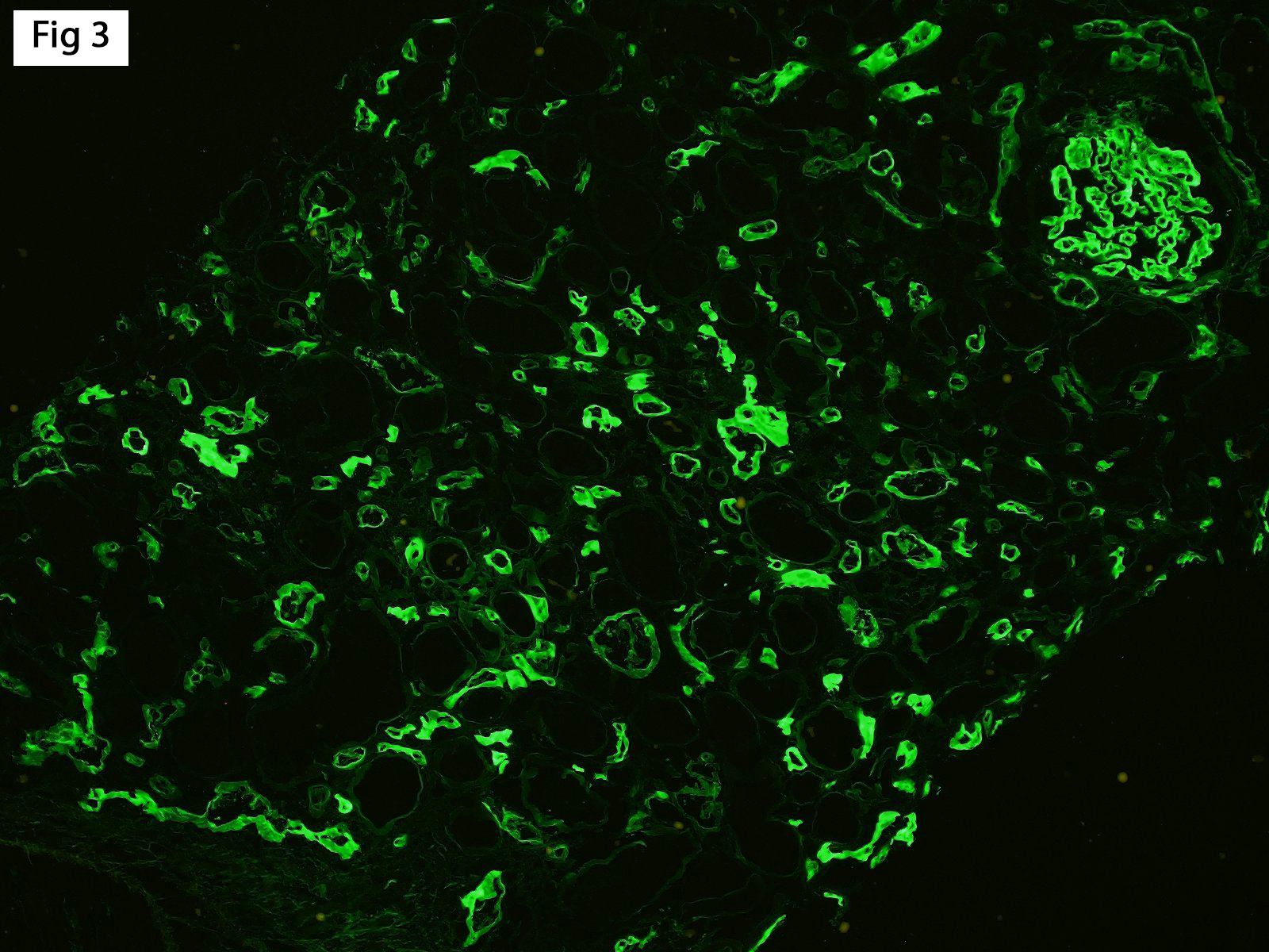 diffusely positive C4d staining in peritubular capillaries, Antibody-Mediated Rejection