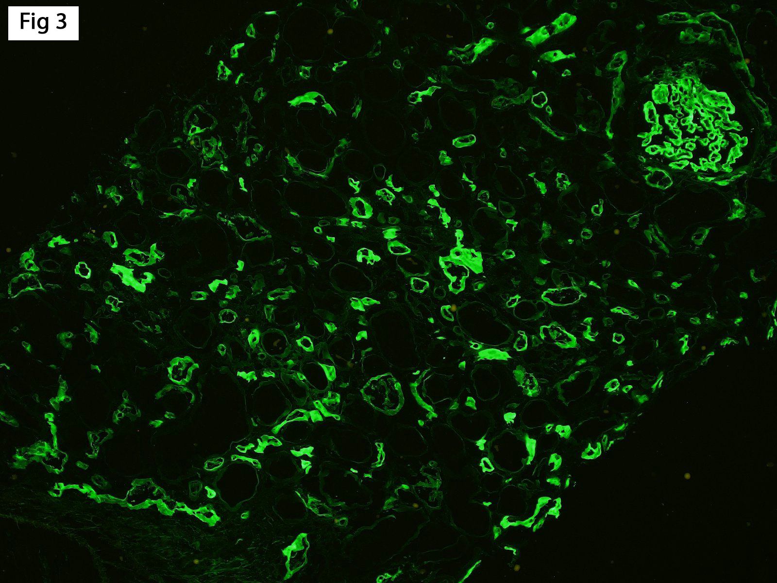 diffusely positive C4d staining in peritubular capillaries, Antibody-Mediated Rejection