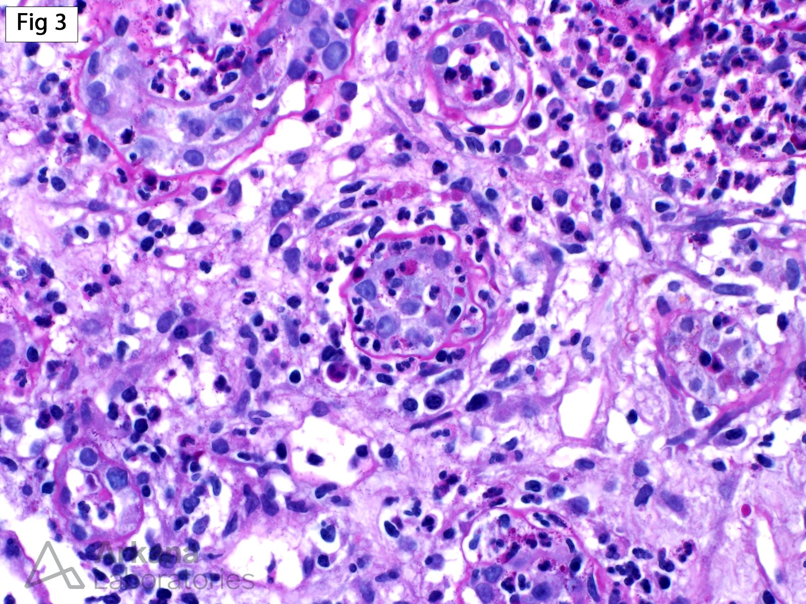 Acute Pyelonephritis