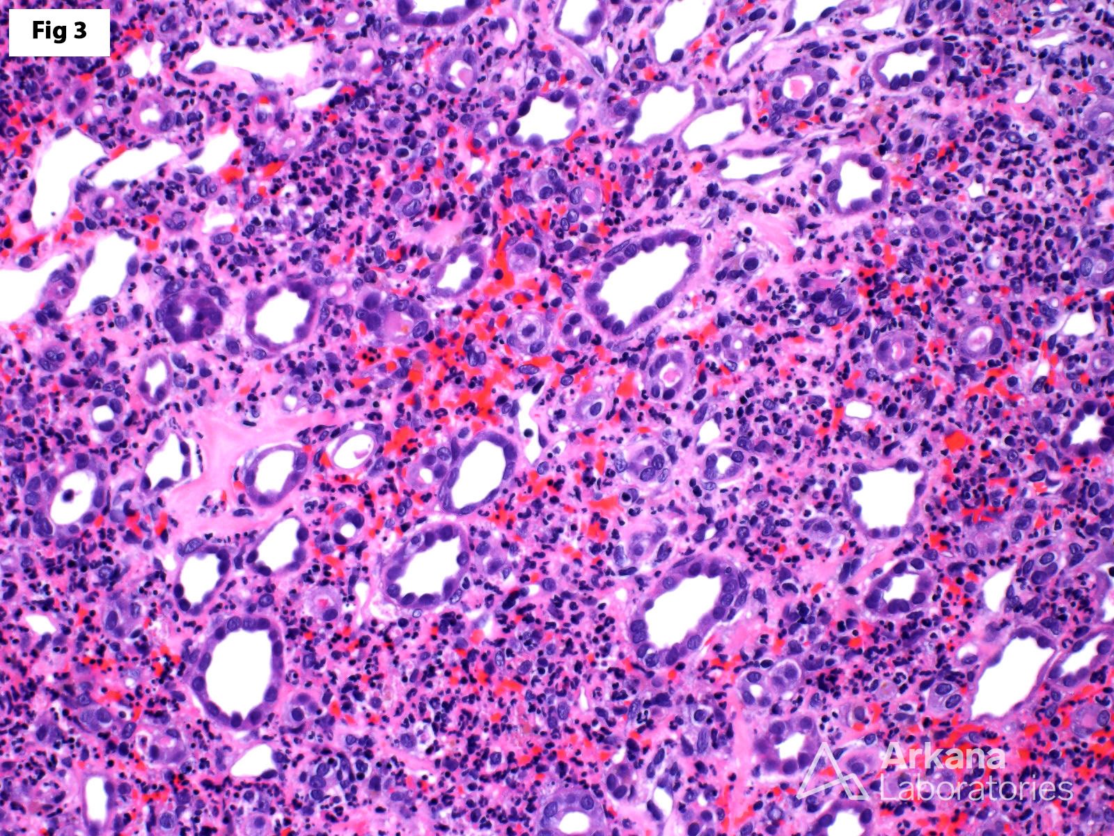 significant neutrophil-rich medullary angiitis