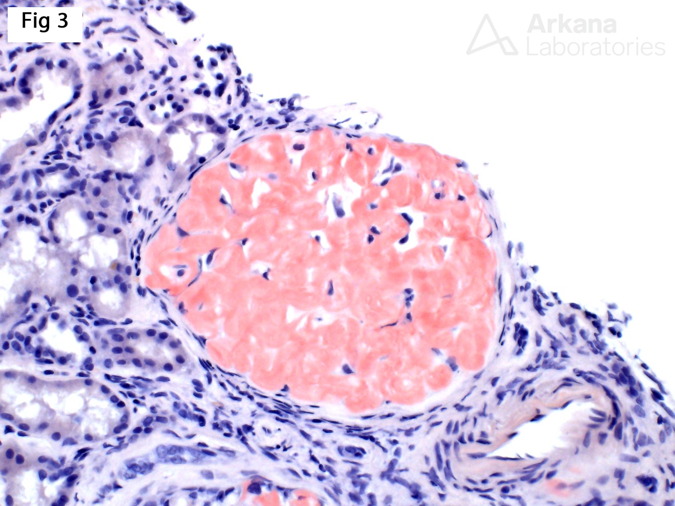 Fibrinogen Aα-chain Amyloidosis