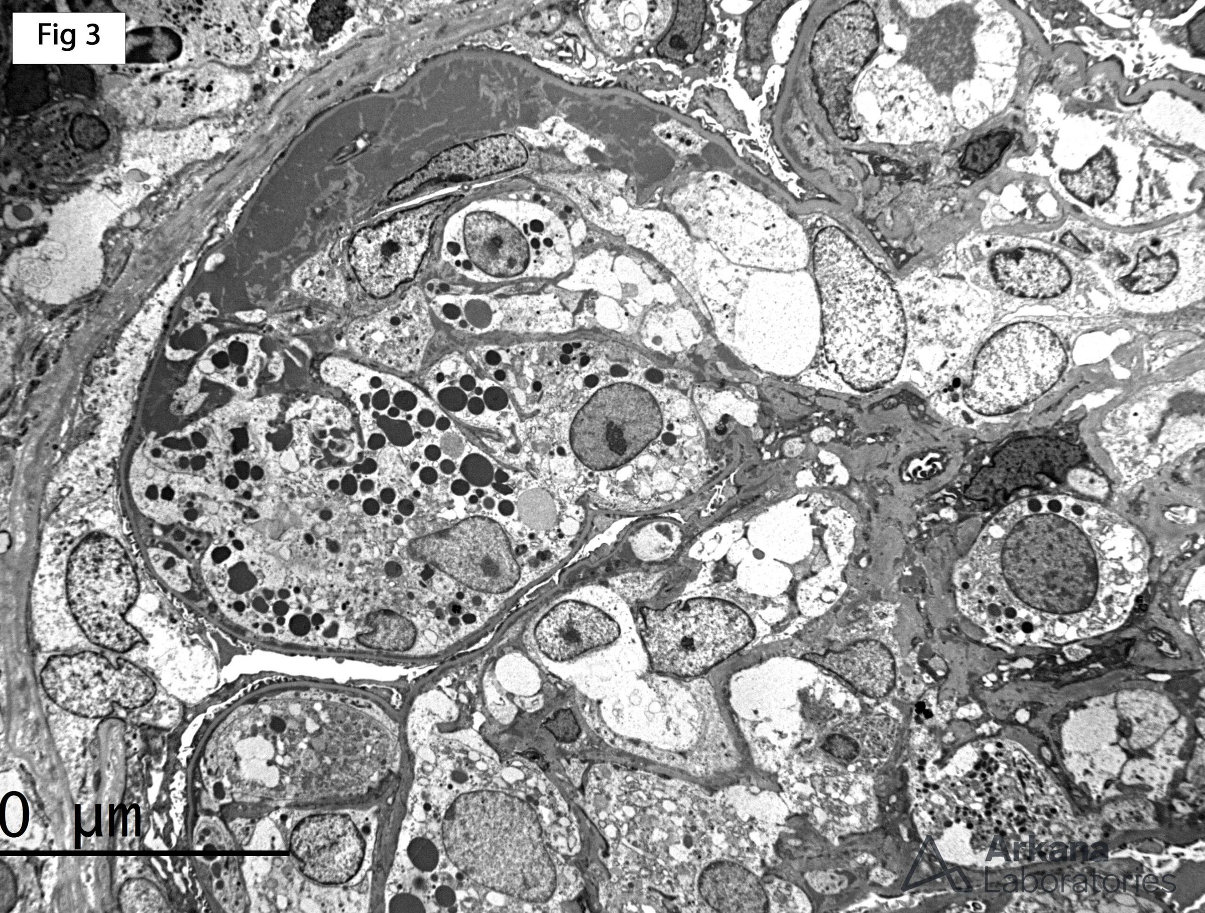 Cryoglobulinemic Glomerulonephritis