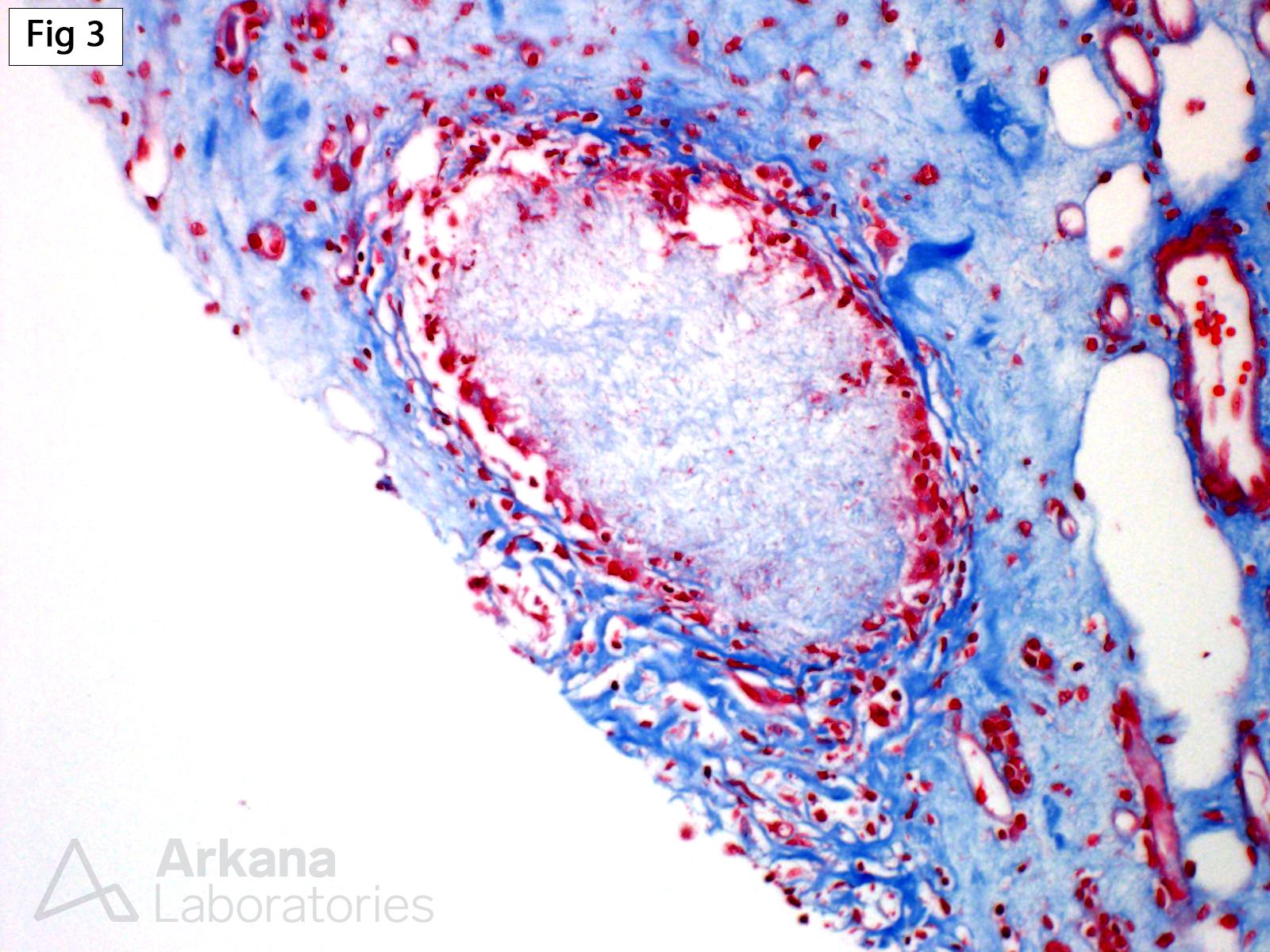 Chronic Uric Acid Nephropathy