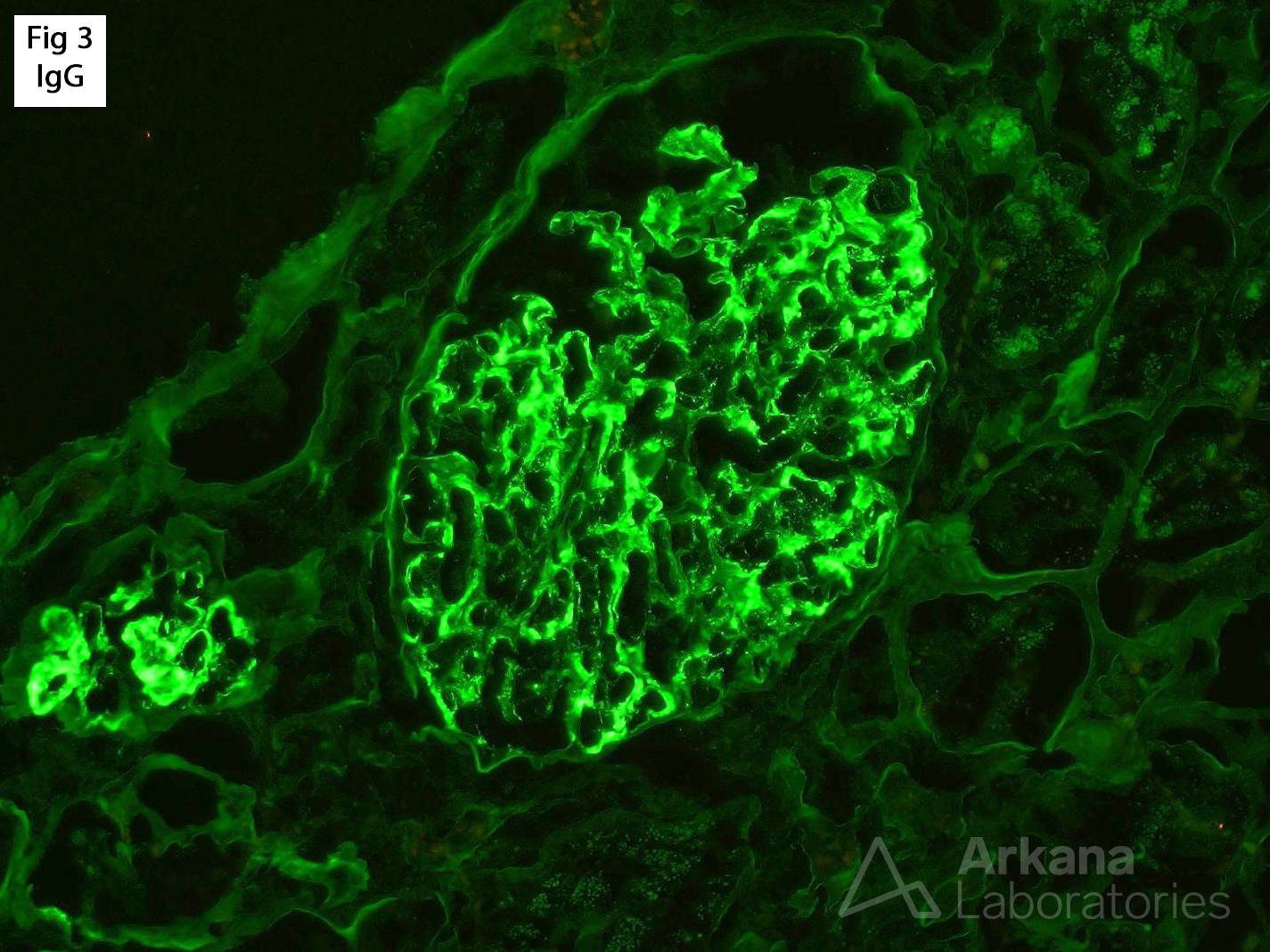 Proliferative Glomerulonephritis with Monoclonal IgG Deposits