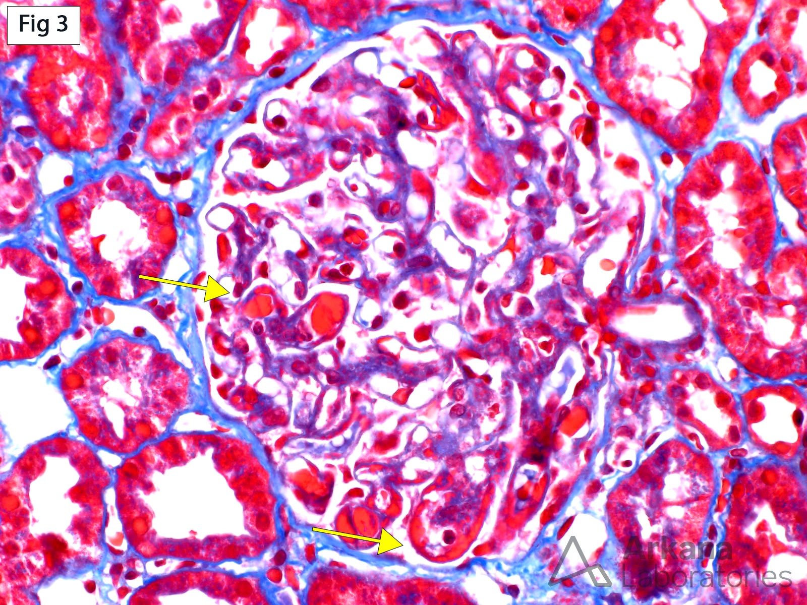 Immune Deposits in SLE