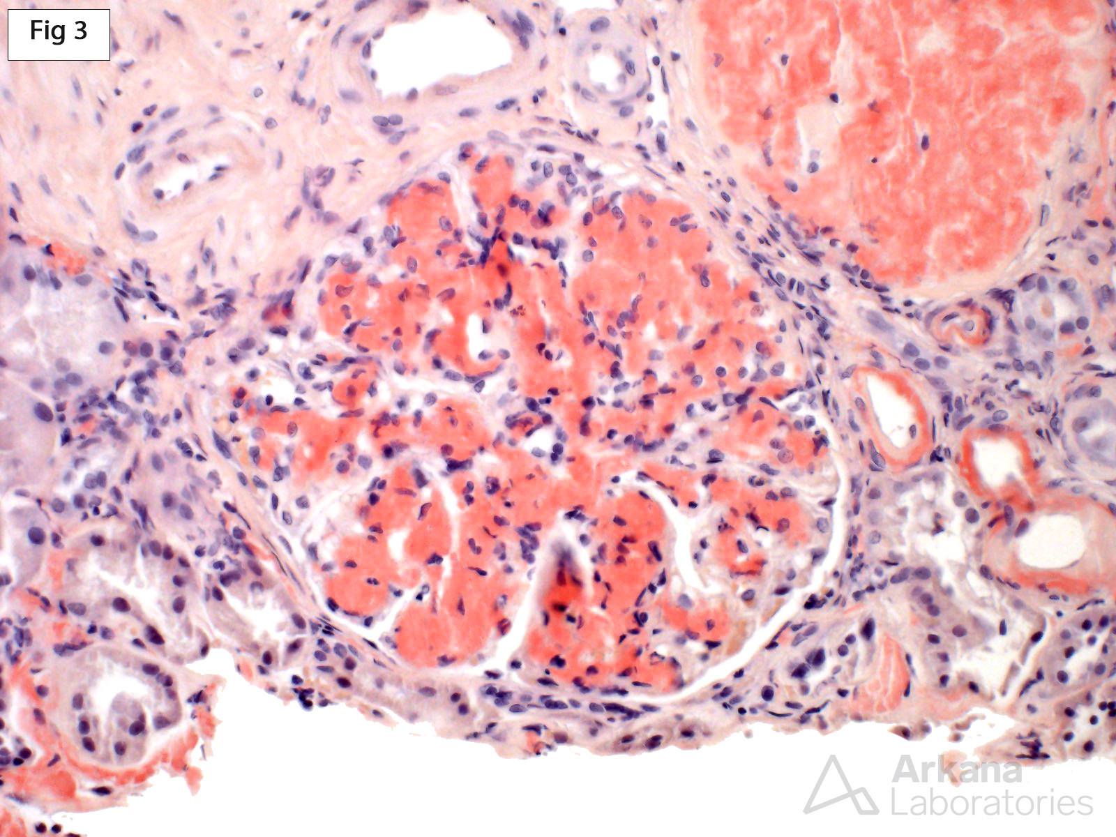 LECT2 Amyloidosis