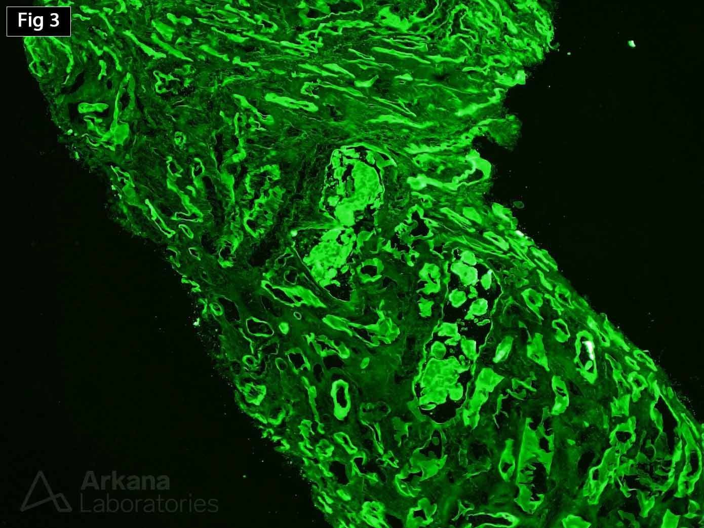 Light Chain Cast Nephropathy with Congo Red Staining