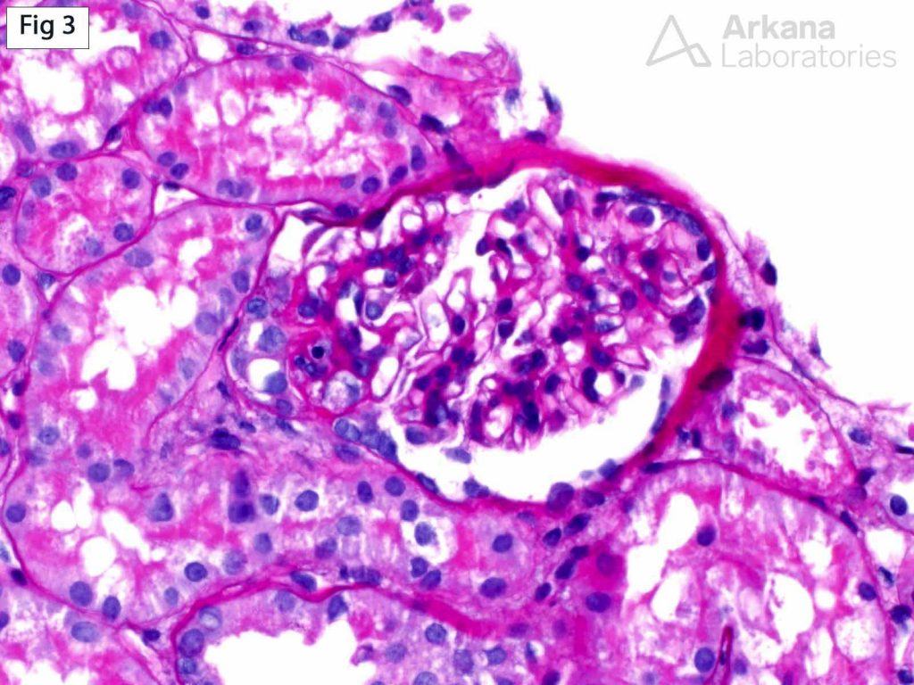 Focal Segmental Glomerulosclerosis (FSGS)