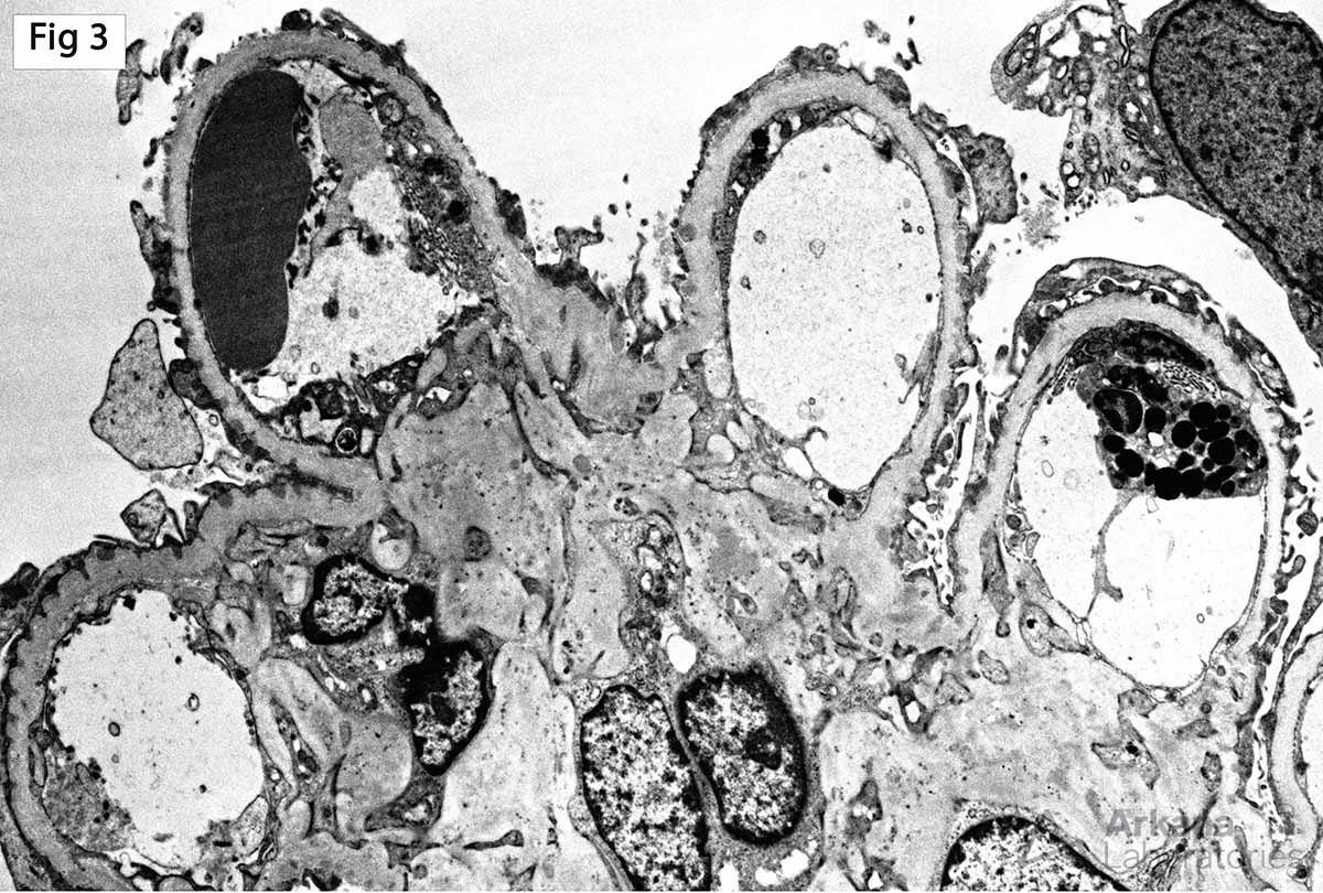 small subepithelial deposits with minimal reaction of the surrounding glomerular basement membrane by electron microscopy, Diabetic Glomerulosclerosis 