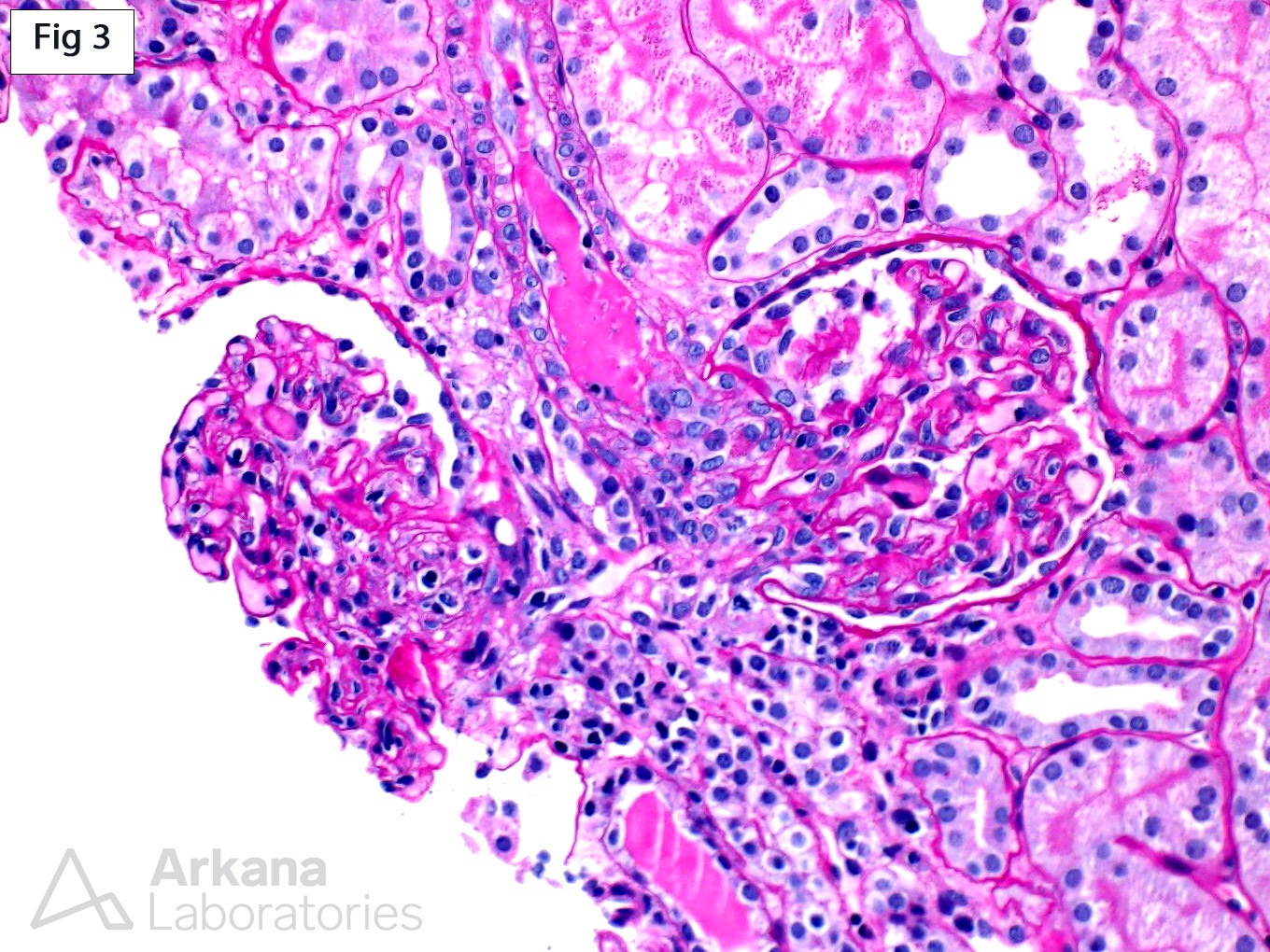 Thrombotic Microangiopathy