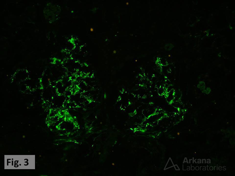 diffuse glomerular immune complex deposits, Arterial Thromboemboli