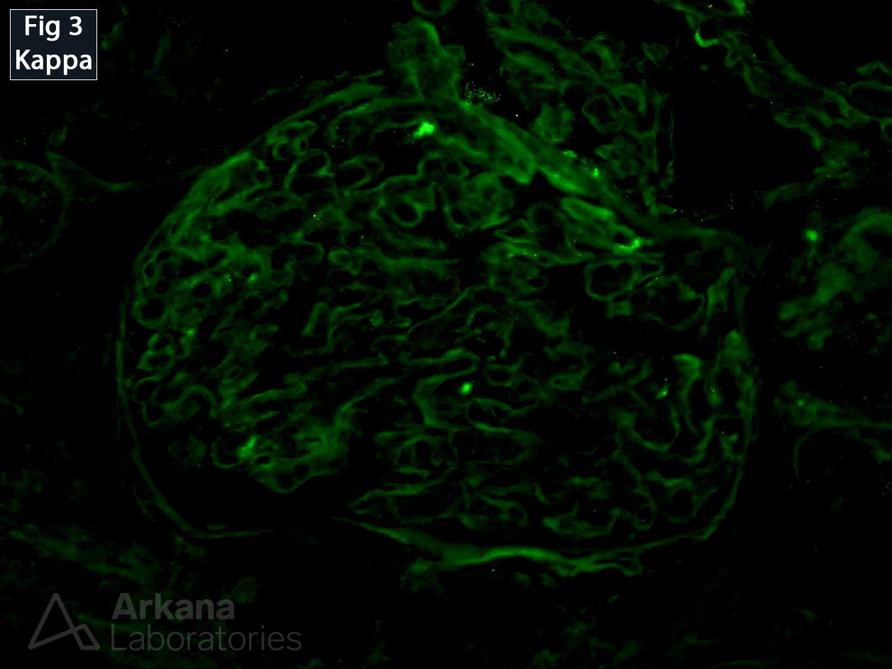 Proliferative Glomerulonephritis with Monoclonal IgG Deposits