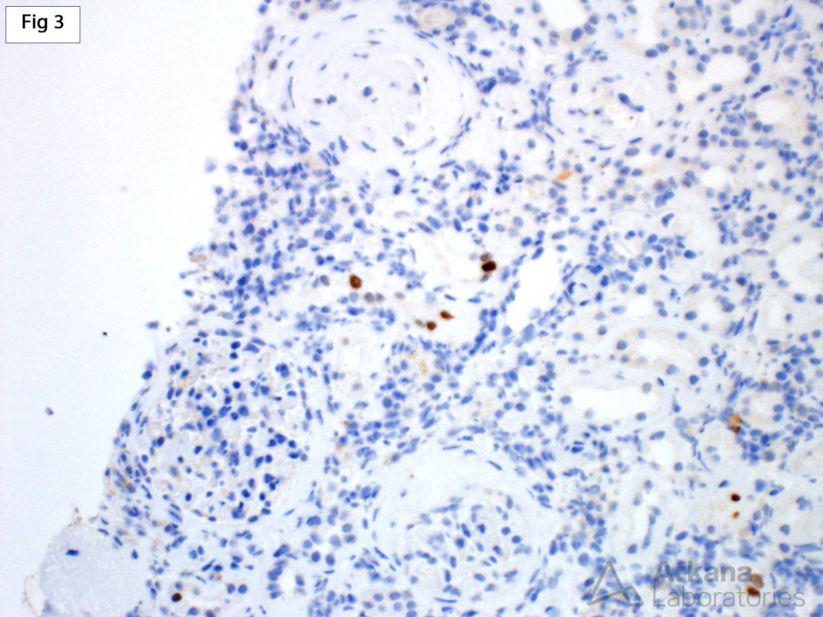 Polyomavirus Nephropathy