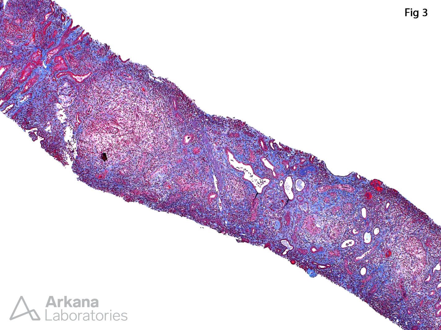 renal cortex in trichrome stain showing Chronic Active Tubulointerstitial Nephritis