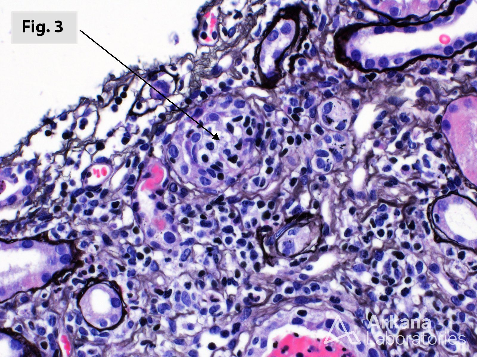 Chronic Active T Cell-Mediated Rejection