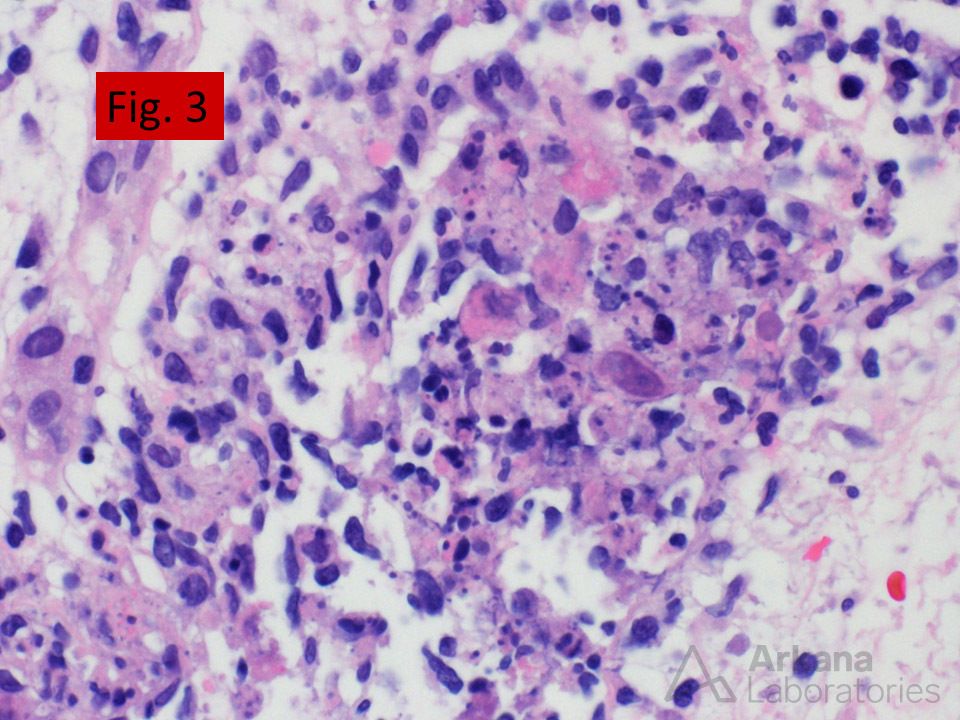 foci of tubular necrosis, Adenovirus