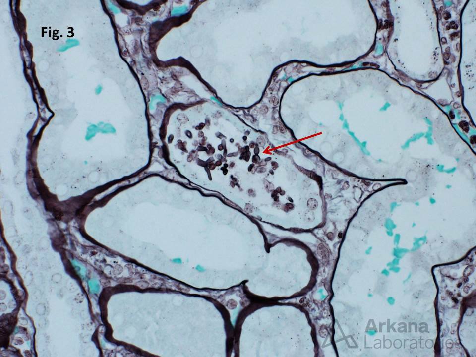 Fungus Microabscess