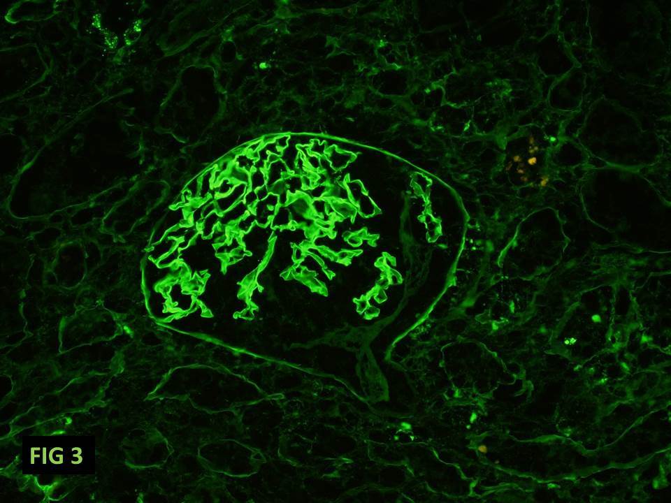 Anti-GBM (Anti-Glomerular Basement Membrane), linear IgG staining of the capillary walls