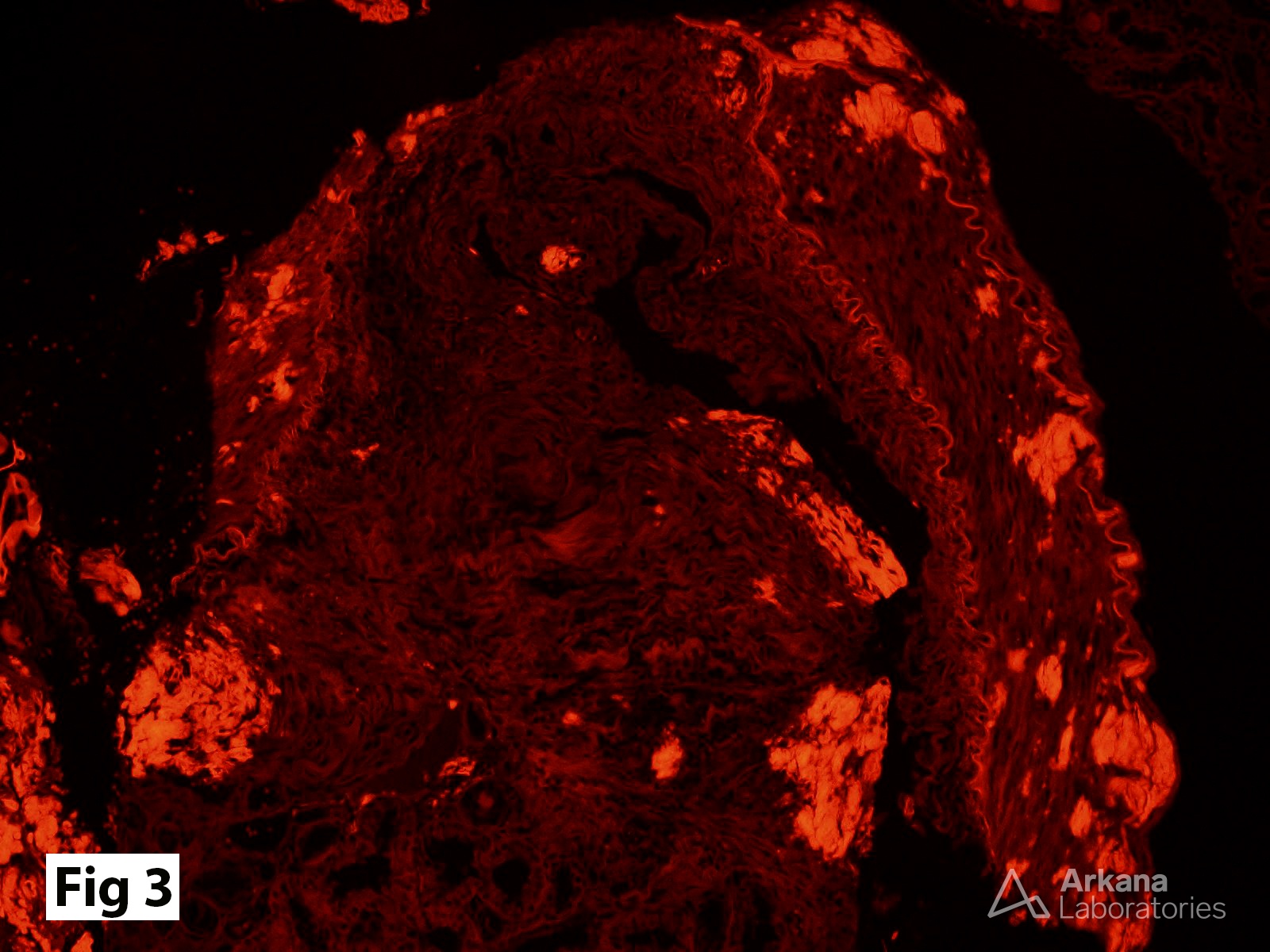 Congo red stain, fluorescence microscopy with Texas red filter