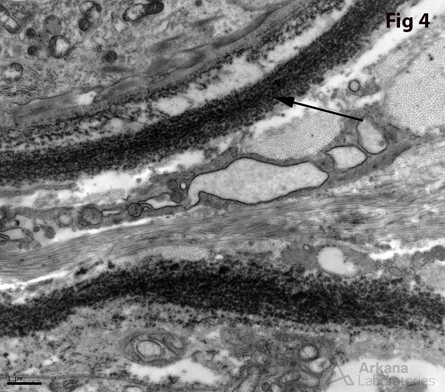 granular deposits along the tubular basement membranes, Peritubular Giant Cells