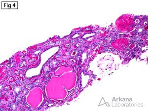 IgA and APOL1-Associated Nephropathy, disappearing and solidified-type globally sclerotic glomeruli along with early microcystic tubular dilatation