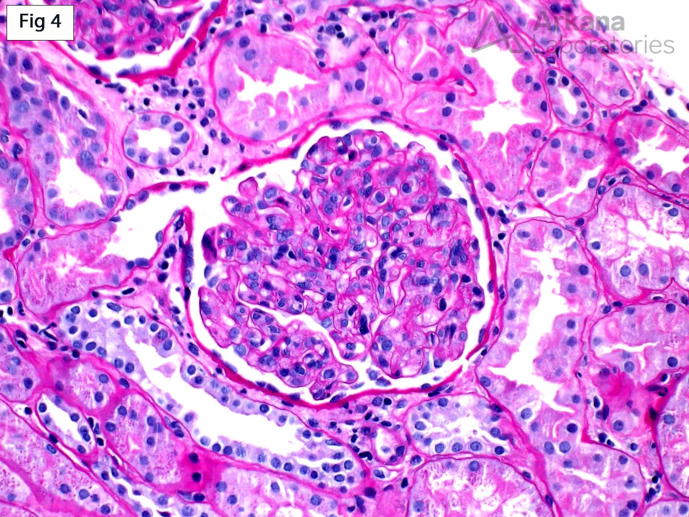 Thrombotic Microangiopathy