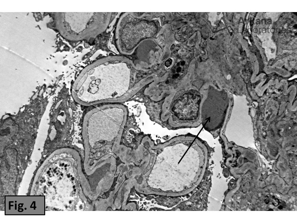 Large paramesangial deposits, Arterial Thromboemboli