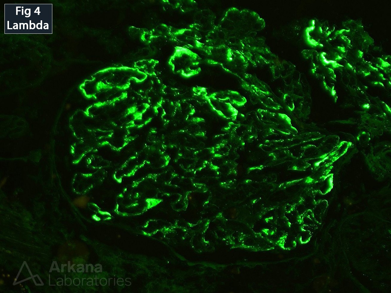 Proliferative Glomerulonephritis with Monoclonal IgG Deposits