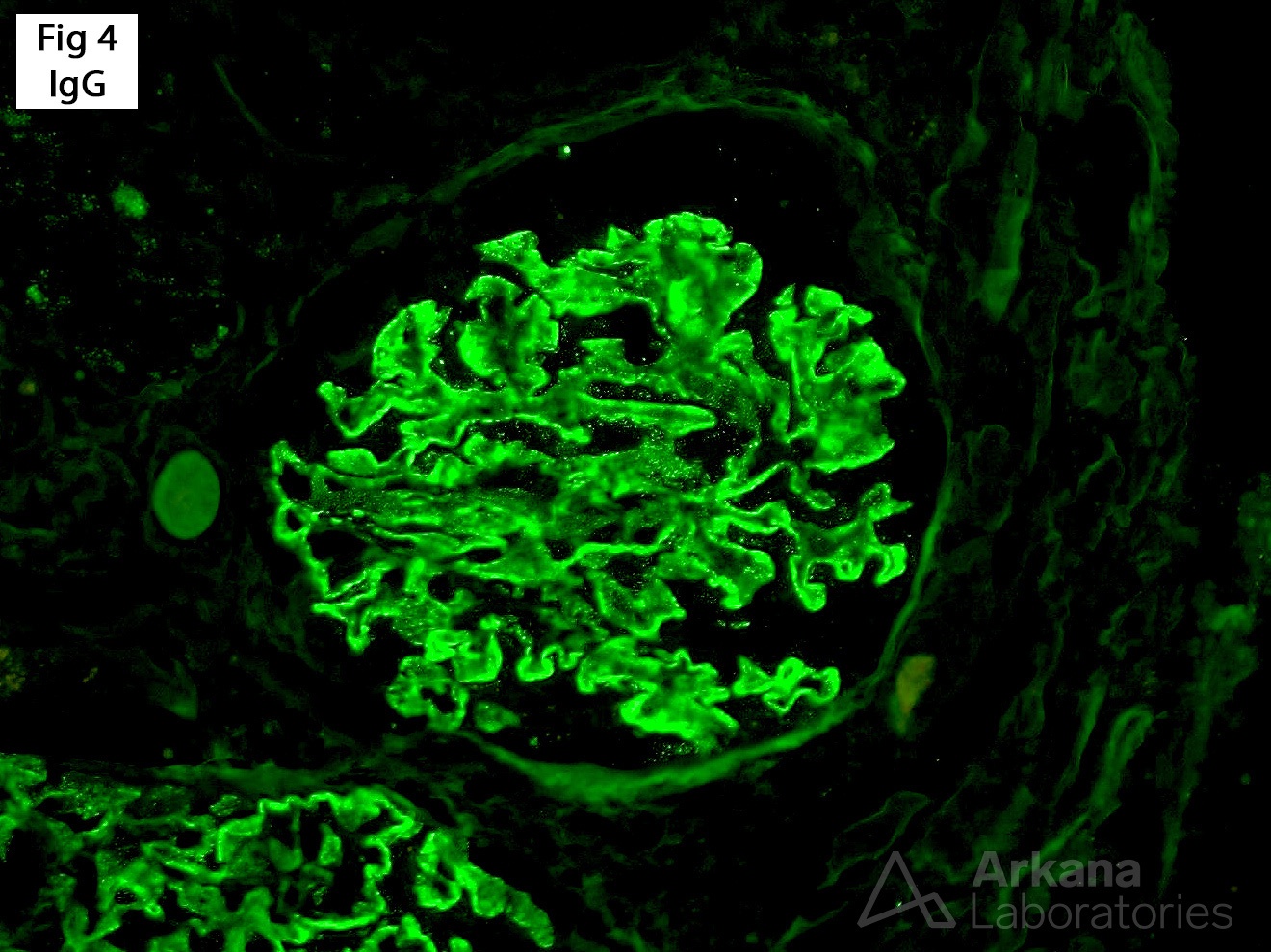 Obesity-Related Glomerulopathy