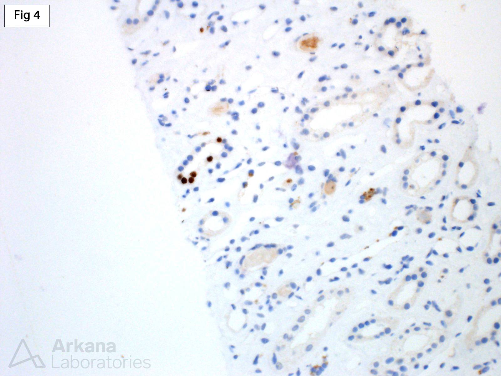 Polyomavirus Nephropathy